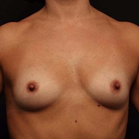 Breast Augmentation Before & After