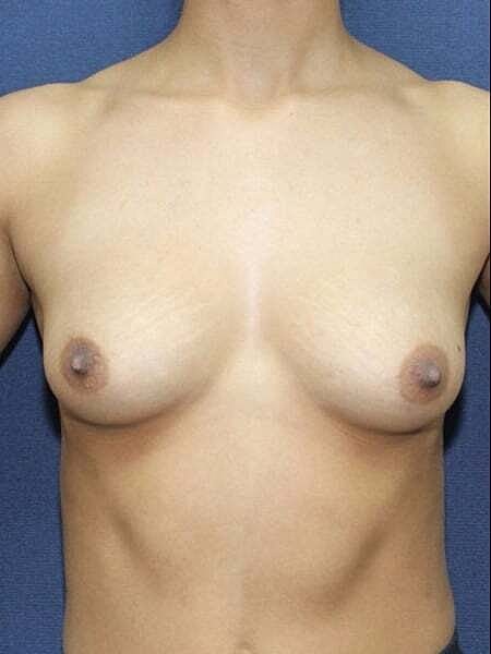 Breast Augmentation Before & After