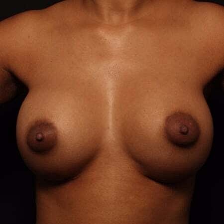 Breast Augmentation Before & After