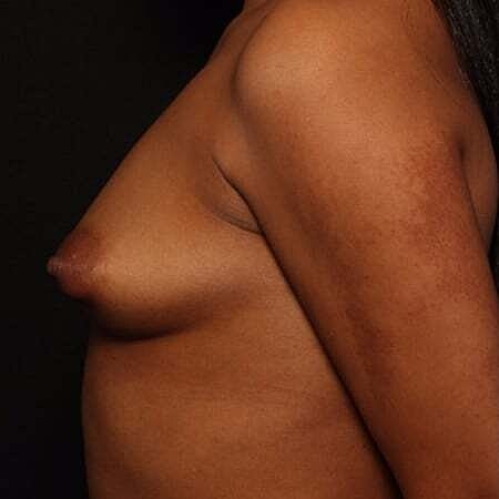 Breast Augmentation Before & After