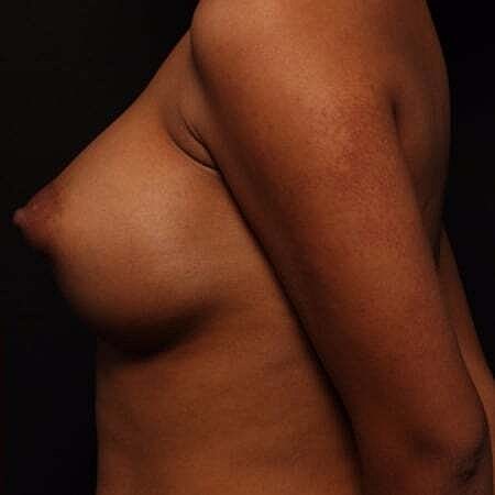 Breast Augmentation Before & After