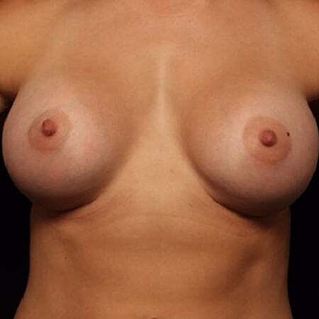 Breast Augmentation Before & After