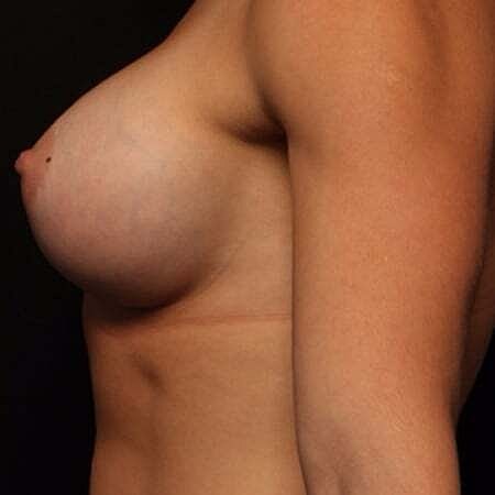 Breast Augmentation Before & After