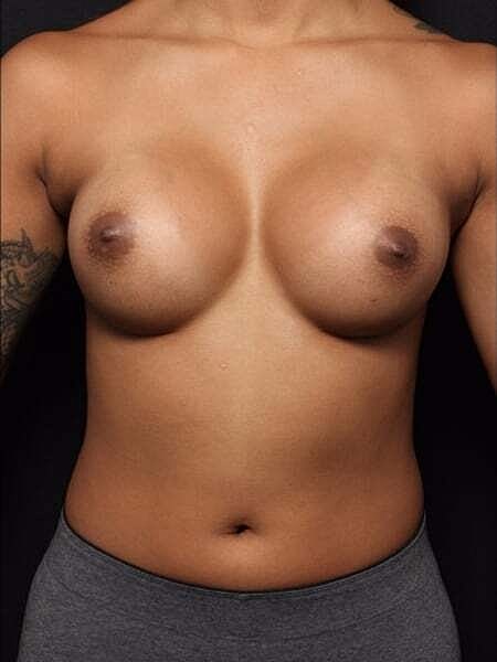 Breast Augmentation Before & After