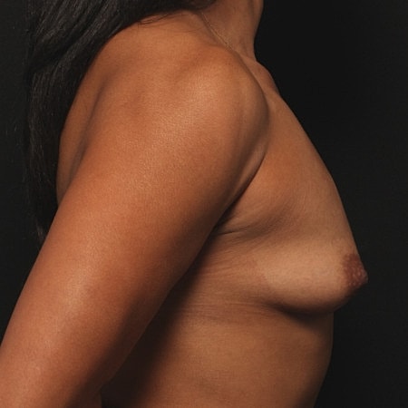 Breast Augmentation Before & After