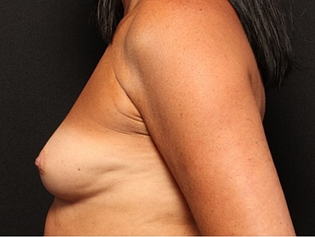 Breast Augmentation Before & After