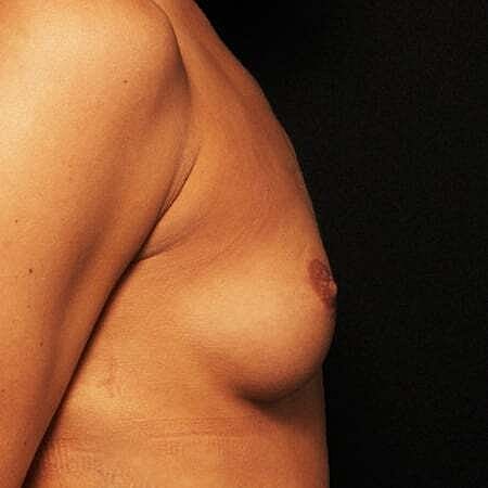 Breast Augmentation Before & After