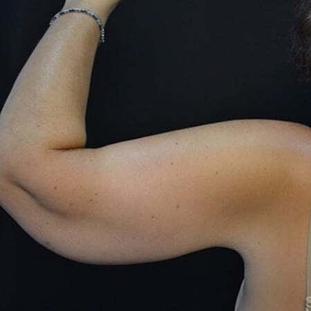 Arm Lift Before & After
