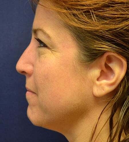 Rhinoplasty Before & After