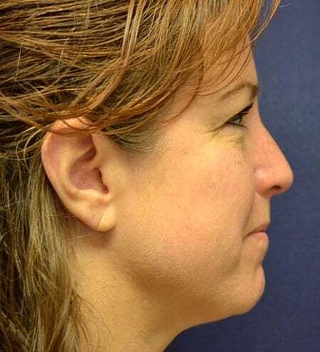 Rhinoplasty Before & After