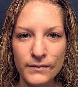 Rhinoplasty Before & After