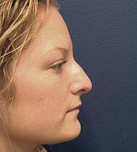 Rhinoplasty Before & After