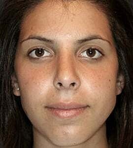 Rhinoplasty Before & After