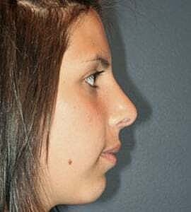 Rhinoplasty Before & After