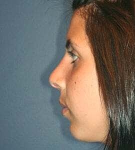 Rhinoplasty Before & After