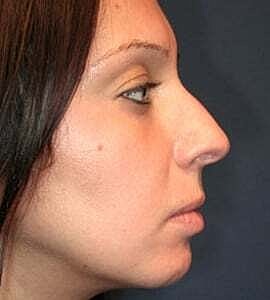 Rhinoplasty Before & After