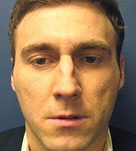 Rhinoplasty Before & After