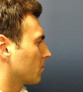 Rhinoplasty Before & After