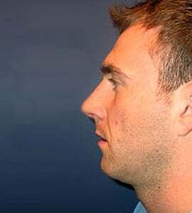 Rhinoplasty Before & After