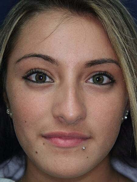Rhinoplasty Before & After