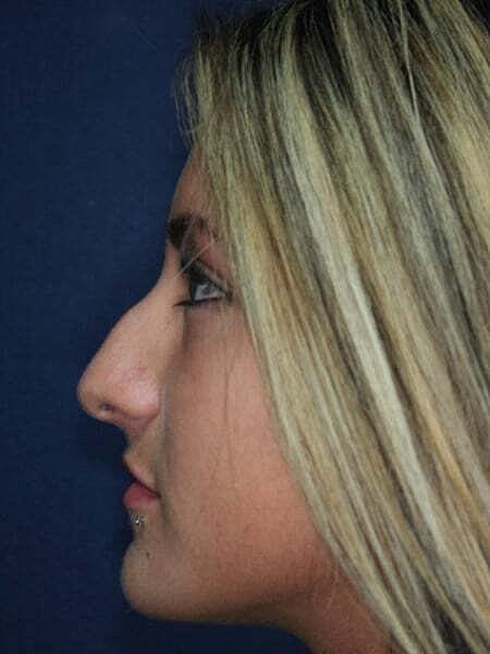 Rhinoplasty Before & After
