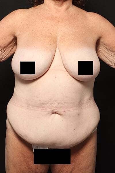 Tummy Tuck Before & After