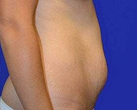 Tummy Tuck Before & After