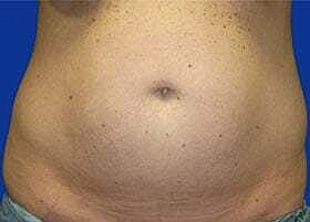 Tummy Tuck Before & After