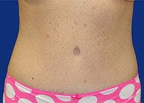 Tummy Tuck Before & After
