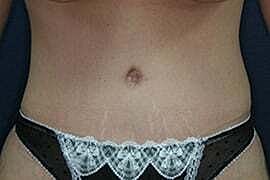 Tummy Tuck Before & After