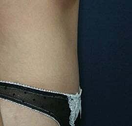 Tummy Tuck Before & After