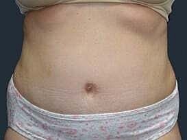 Tummy Tuck Before & After