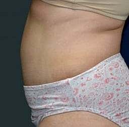 Tummy Tuck Before & After