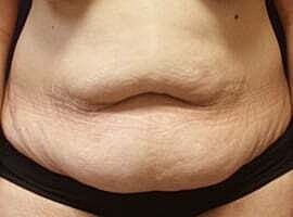 Tummy Tuck Before & After