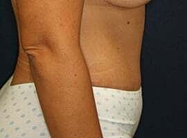 Tummy Tuck Before & After