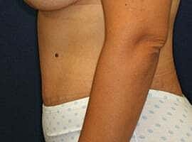 Tummy Tuck Before & After