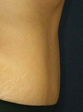 Tummy Tuck Before & After