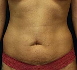 Tummy Tuck Before & After