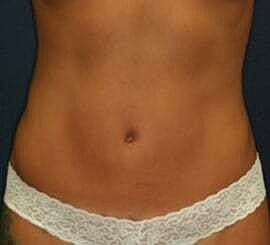 Tummy Tuck Before & After