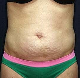 Tummy Tuck Before & After