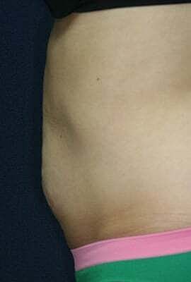 Tummy Tuck Before & After