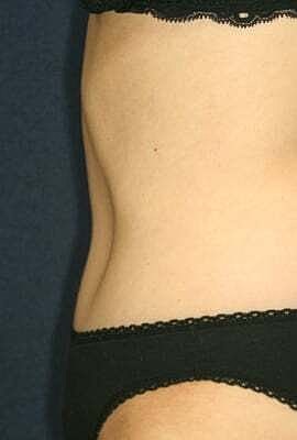 Tummy Tuck Before & After