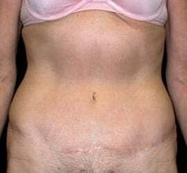 Tummy Tuck Before & After