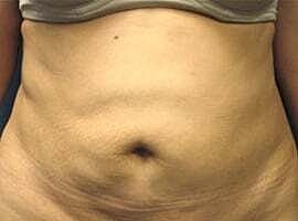 Tummy Tuck Before & After