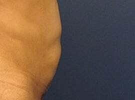 Tummy Tuck Before & After