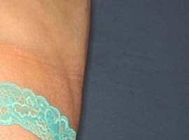 Tummy Tuck Before & After