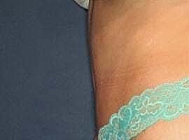 Tummy Tuck Before & After