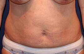 Tummy Tuck Before & After