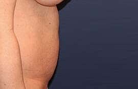 Tummy Tuck Before & After