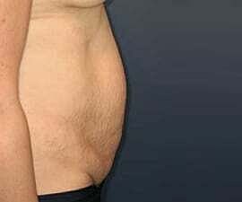 Tummy Tuck Before & After